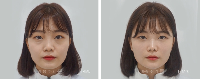 강남본점_큐오필(앞볼, 팔자주름, 턱끝)