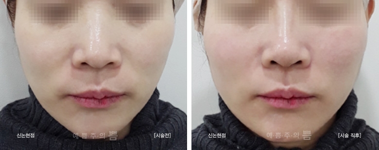강남본점_하이코+실리프팅