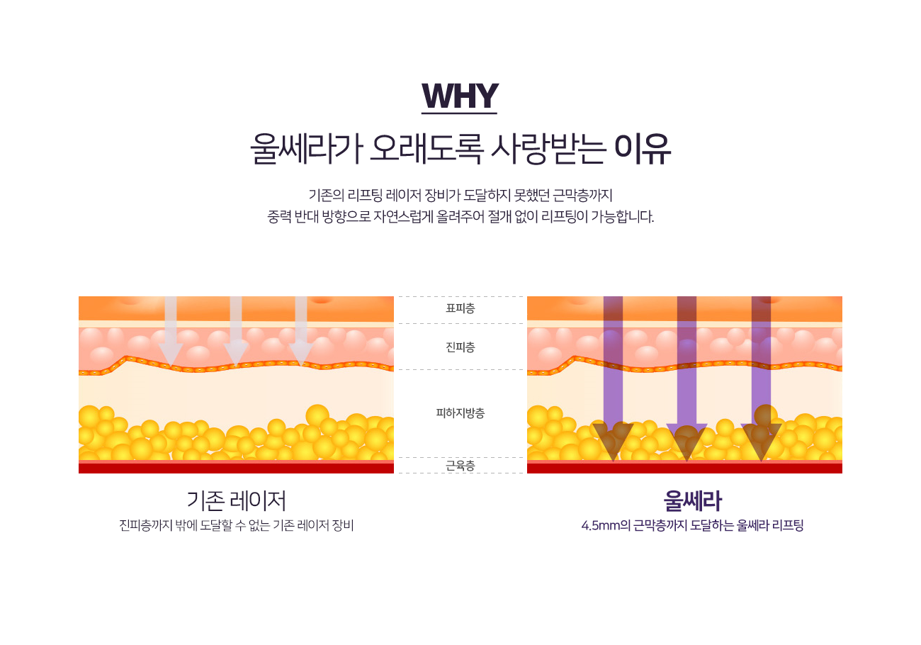 울쎄라가 사랑 받는 이유